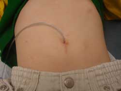 Appendix connected to the belly button.